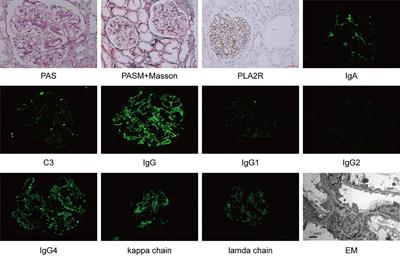 Concurrent IgA Nephropathy and Membranous Nephropathy, Is It an Overlap Syndrome?